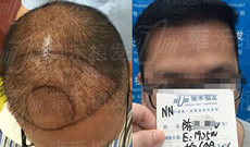 “圈套”式脱发陈先生在南宁雍禾植发1905单位半年后效果