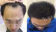 大家看我花了5万块钱在济南科发源植发2500单位效果如何