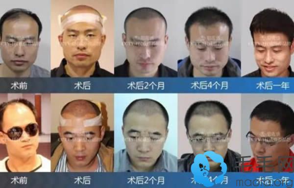 深圳碧莲盛曹国荣植发案例 深圳碧莲盛曹国荣植发案例