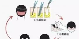 4月10日舉行植發(fā)專(zhuān)場(chǎng) 毛發(fā)移植常見(jiàn)問(wèn)題都在這里