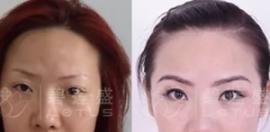 在碧莲盛植个眉毛3000元够吗 有没有种植前后的对比图