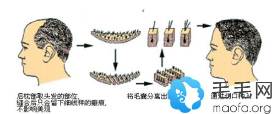 植发后2年又掉光和采用FUT植发技术种植头发有关系吗？看FUE 植发原理