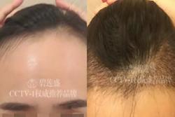 南京碧莲盛郭大伟发际线调整案例，种植2500单位后疑似整容
