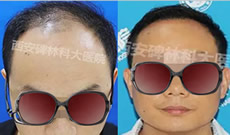 植发能减龄？M型脱发男士西安碑林科大植发后年轻了10岁