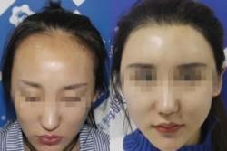 为了改善大饼脸，我找福州海峡朱声扬花3.2万种植了发际线