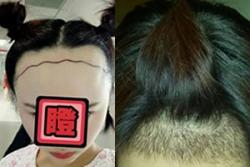 我比较了和的植发价格后,让给我种植了发际线