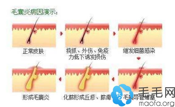 毛囊炎形成的原因示意图