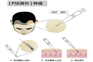 微针植发技术怎么样？从科发源植发案例效果及恢复过程看