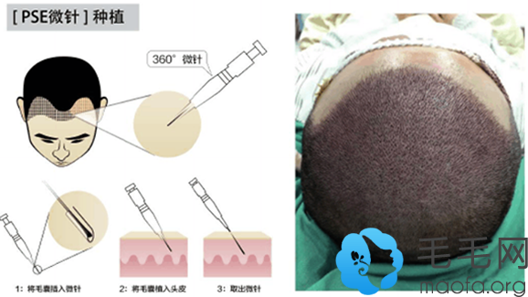 使用PES微针植发技术后的发友及次技术原理