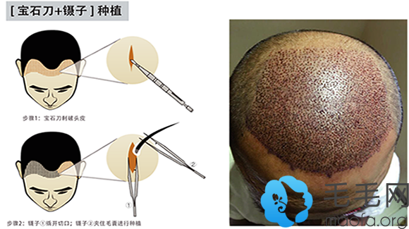 采用传统种植后<span style=