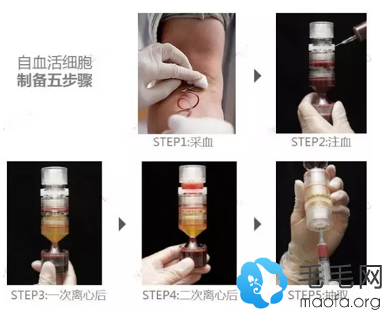 PRP制备5个步骤