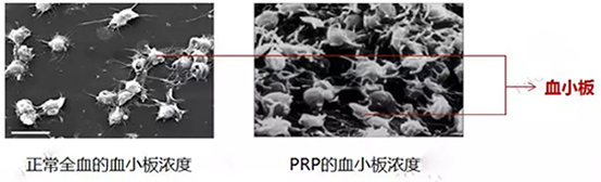 PRP的血小板浓度和正常血小板浓度对比图