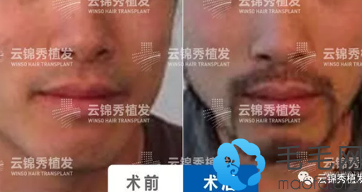 云锦秀男士胡须种植案例对比照