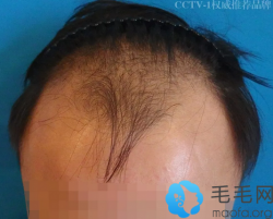回顾我2017年去南宁碧莲盛掏4.9万种植头发的恢复效果及感受