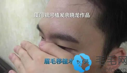 厦门银河男生植眉7天侧面效果图