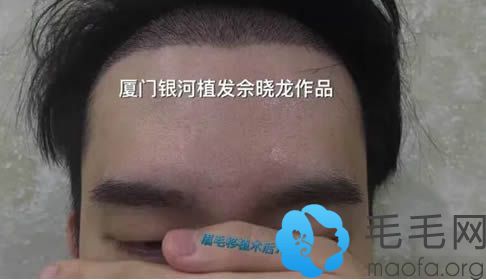 种植眉毛和发际线7天效果图