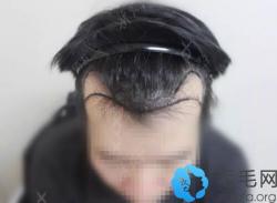 各位来看下我在天津新发现做额角植发9个月的效果照怎么样