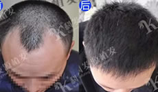 宝宝们我在天津科发源的植发案例上线了 朋友说效果不一般