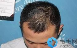 我刚去重庆做了发际线调整及植眉 迫不及待来晒照啦
