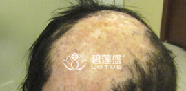 北京碧莲盛疤痕植发真人案例来用验证：疤痕植发能做吗