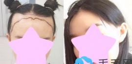 雍禾植发疗效深度测评：北京/上海/成都多位网友高清对比图曝光