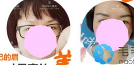剛更新的鄭州醫(yī)德佳醫(yī)院植發(fā)價(jià)格+發(fā)友評(píng)價(jià) 揭曉植發(fā)效果好