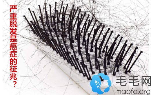 頭發(fā)脫發(fā)嚴(yán)重是癌癥的信號(hào)？北京蔣文杰揭秘真相