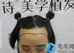 现分享我去南昌花3.7万种植发际线的经历及90天恢复照