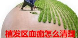 北京科普 怎样去掉植发区的血痂+植发后后脑勺疼怎么办