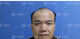 南宁贞韩植发怎么样？覃先生告诉你他选择南宁贞韩的原因