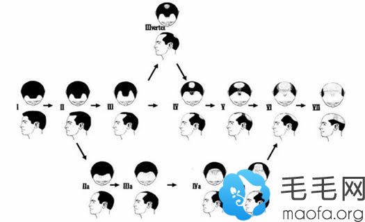 脱发一般分为7级12型