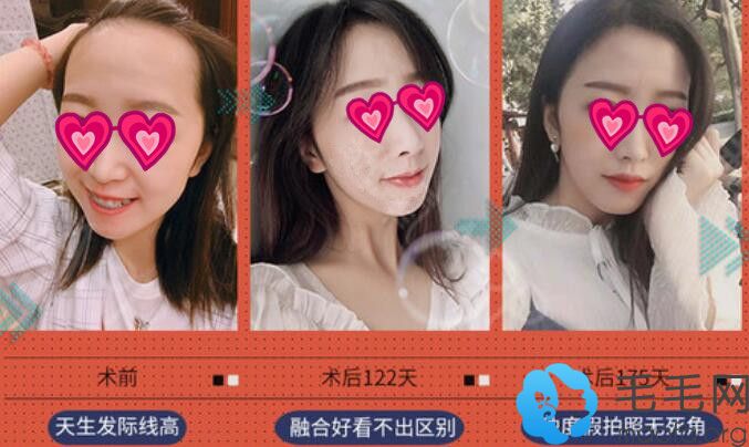 上海科发源微针种植发际线术后变化过程图