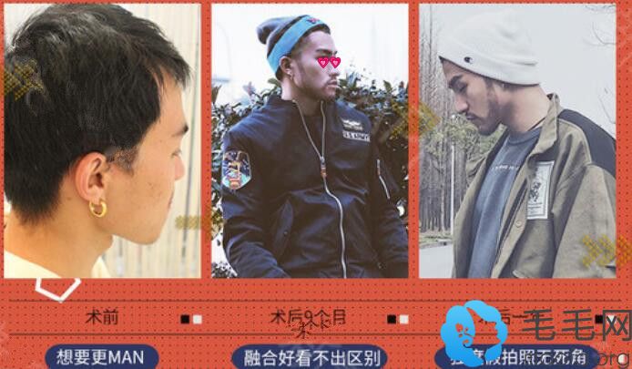 科发源胡须种植靠谱吗？请看济南科发源微针种植胡须案例