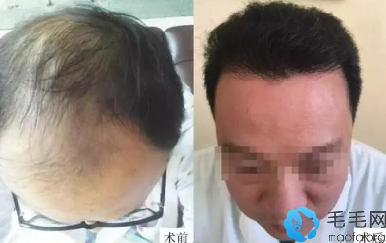 拉萨维多利亚第二代FUE无痕植发案例前后效果对比
