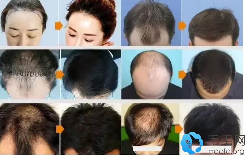 众多发友在拉萨维多利亚植发案例为其验证