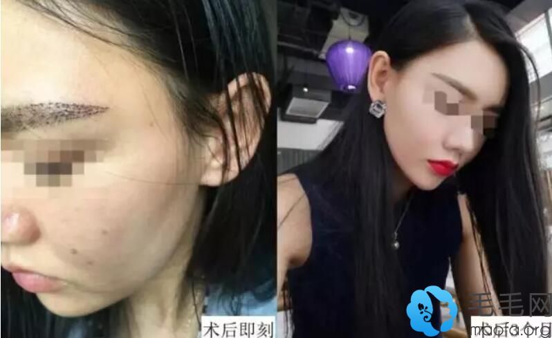 维多利亚无痕植眉案例
