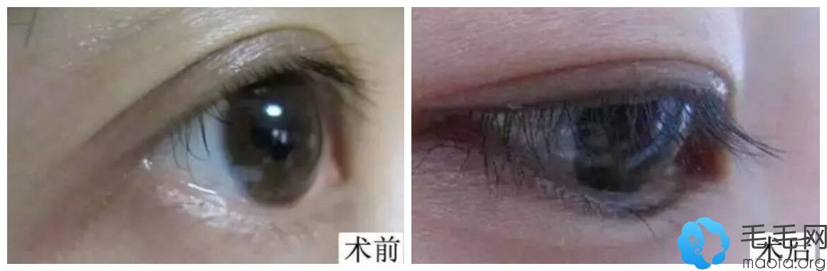 第二代FUE无痕植睫毛案例