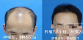 上海莱森植发李梅科普 头发稀疏适合植发吗治疗方法有哪些
