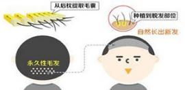 植發(fā)后后腦勺會(huì)禿嗎頭發(fā)還能長嗎 成都首瑞植發(fā)汪軍怎樣說