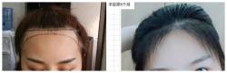 找贾建武植发际线，是在朋友找他植发成功后2年