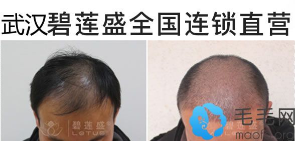 男士头顶稀疏加密种植案例对比图