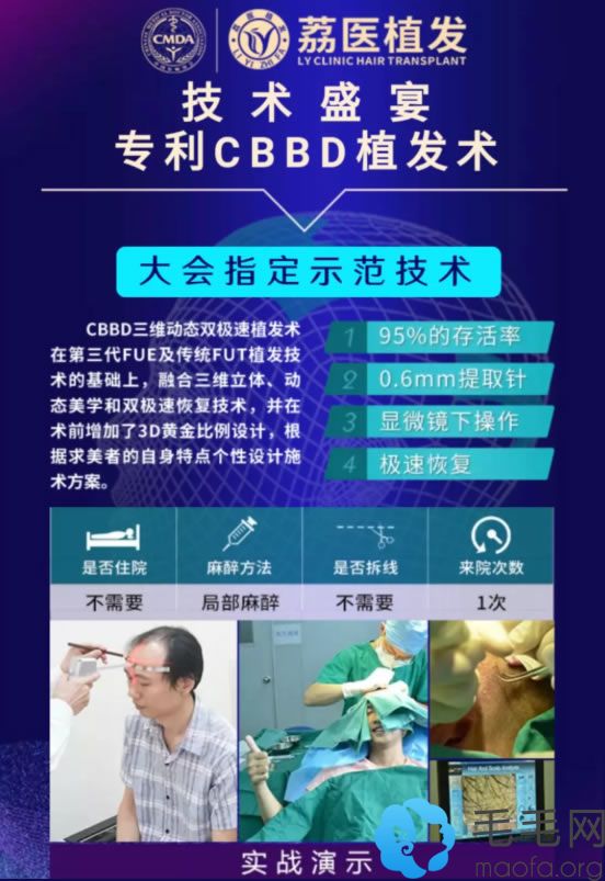 广州荔医植发CBBD技术简介