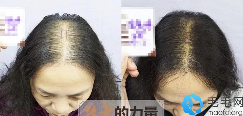 女性脱发怎么办？看瑞丽诗女性头顶稀疏加密种植案例