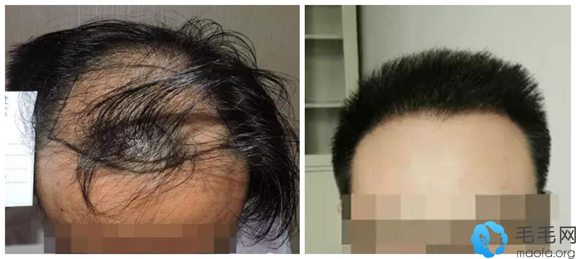雍禾4000单位毛囊面积图及植发后效果图对比