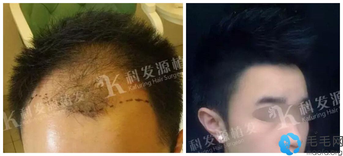 秃顶在上海科发源种植4000单位效果图对比