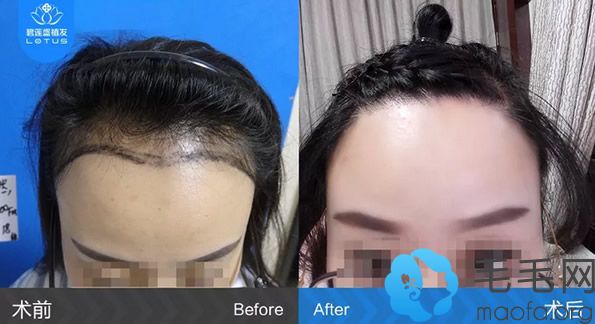 厦门碧莲盛女生种植发际线效果案例