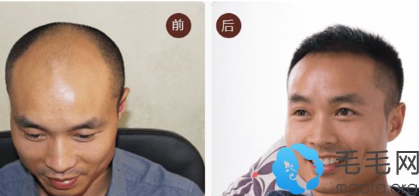 广州瑞丽诗六级脱发植发案例