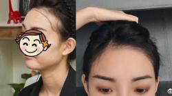 聊聊我让广州碧莲盛张于锋种植发际线手术价格和效果如何