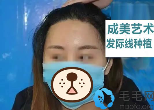 在哈尔滨成美种植发际线12个月后恢复效果