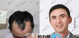 无论是头发加密还是发际线调整 来瑞丽诗植发后效果都很好